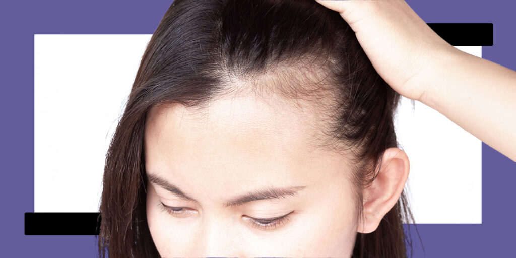 Hair Loss: Understanding Baldness in Females
