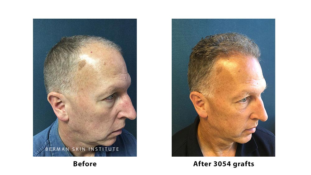 Hair Transplant Before and After Results–Dr. Berman–ARTAS® Robotic Hair Restoration Hair Transplant Before and After Results–Dr. Berman–ARTAS® Robotic Hair Restoration