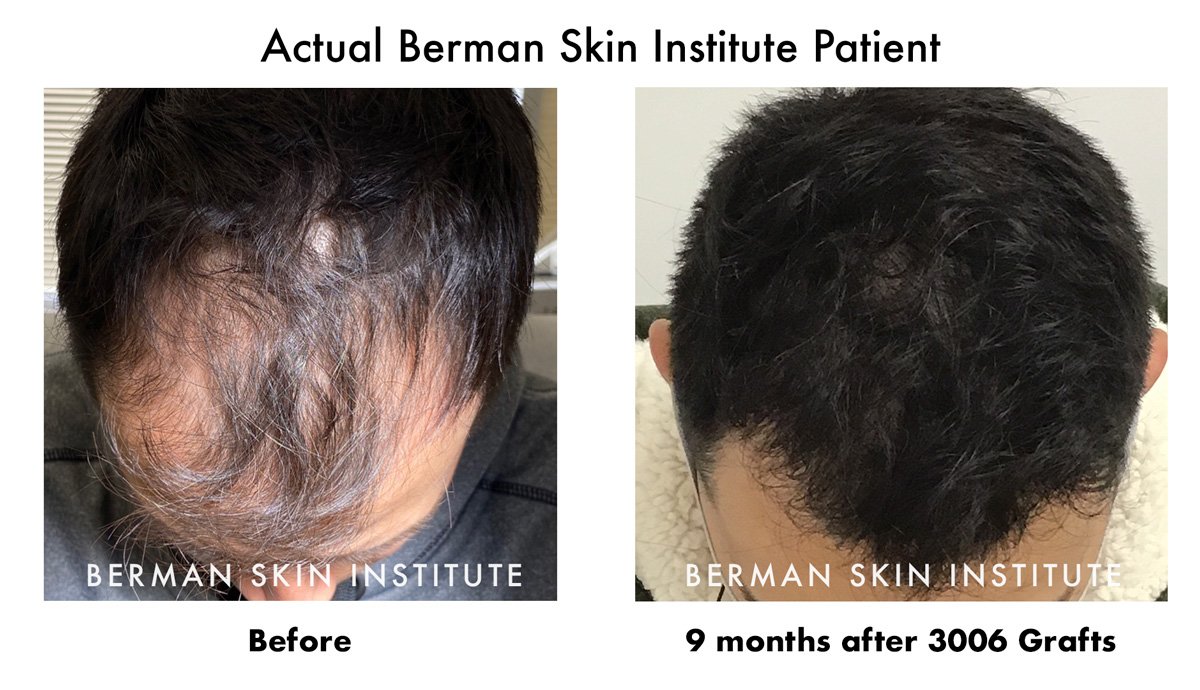 Hair Transplant Before and After ResultsāDr. BermanāARTASĀ® Robotic Hair Restoration Hair Transplant Before and After ResultsāDr. BermanāARTASĀ® Robotic Hair Restoration