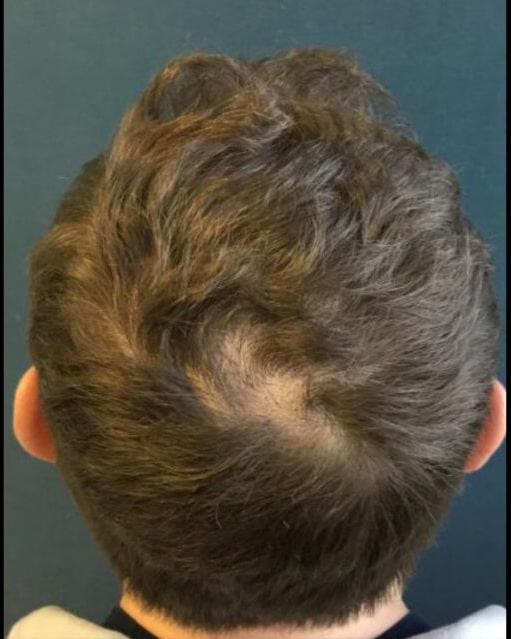 After Image: Hair Transplant - back
