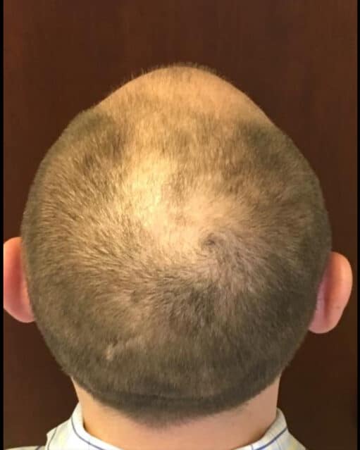 Before Image: Hair Transplant - back