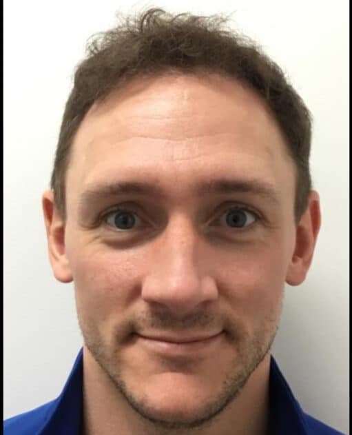 After Image: Hair Transplant - front