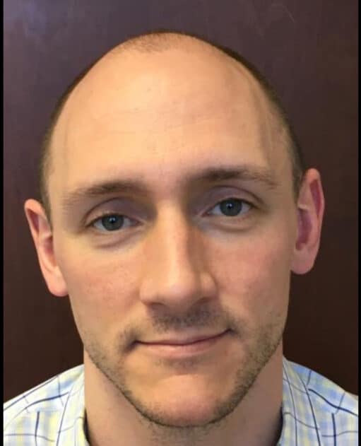Before Image: Hair Transplant - front
