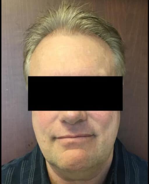 After Image: Hair Transplant - front