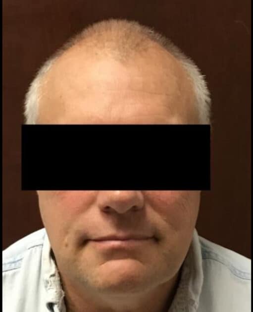 Before Image: Hair Transplant - front