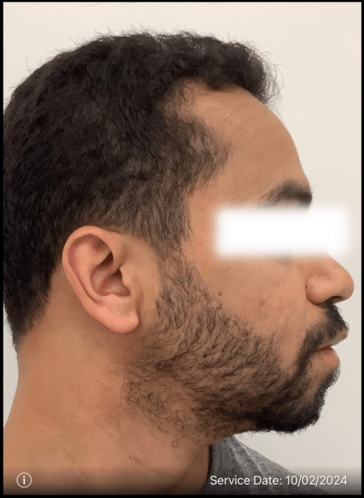 After Image: Beard Transplant - right-side