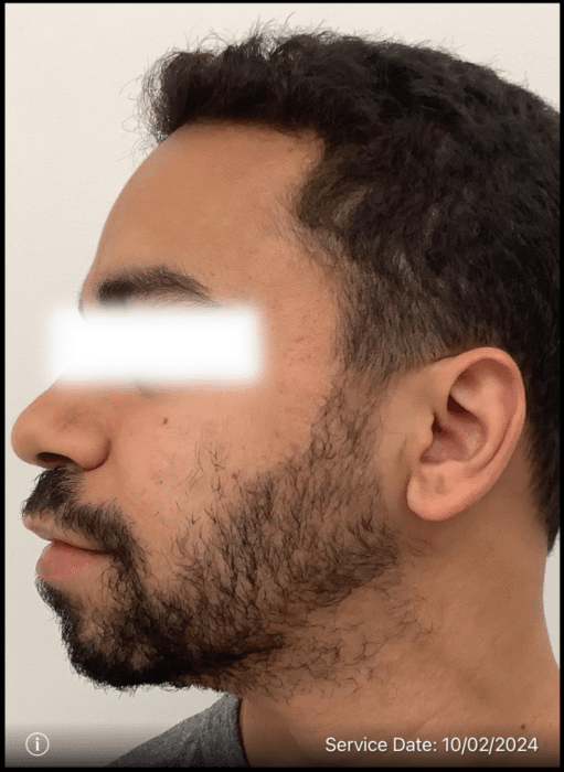 After Image: Beard Transplant - left-side