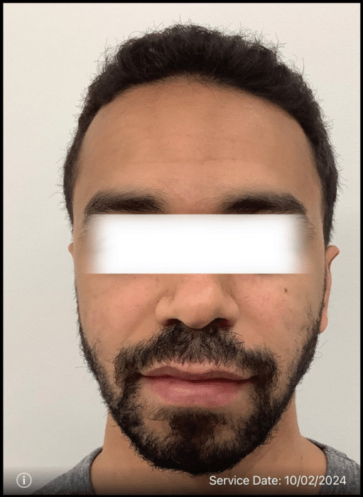 After Image: Beard Transplant - right-side