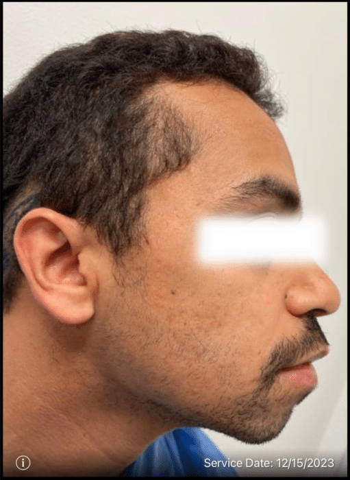 Before Image: Beard Transplant - right-side