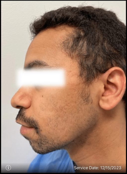 Before Image: Beard Transplant - left-side