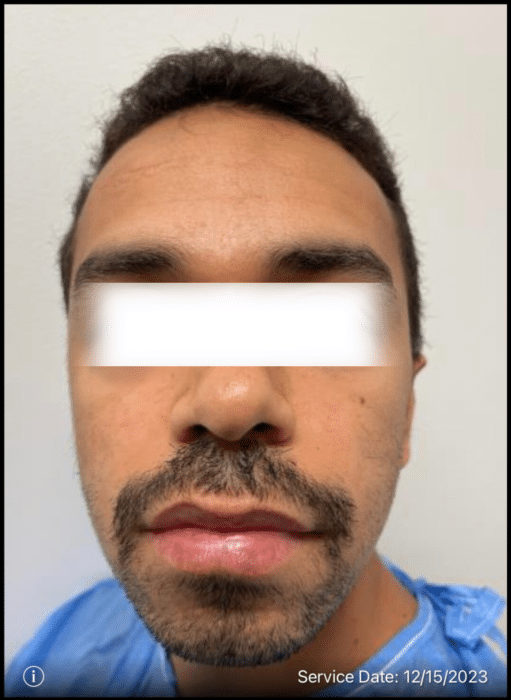 Before Image: Beard Transplant - right-side