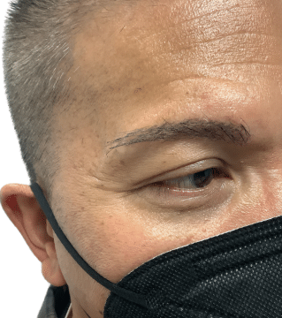 After Image: Eyebrow Transplant - right-front-oblique