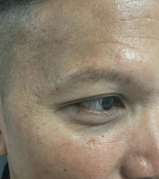 Before Image: Eyebrow Transplant - right-front-oblique
