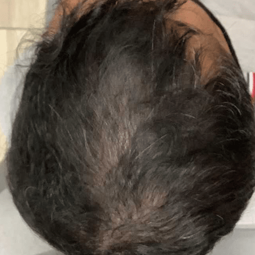 Before Image: HairRevive Boost - back
