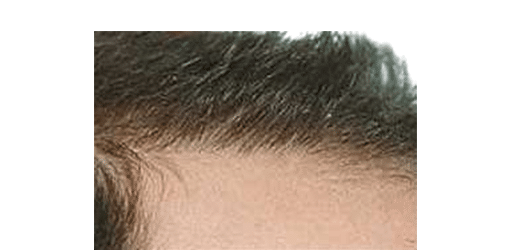 After Image: Strip-FUT Hair Transplant - right-side