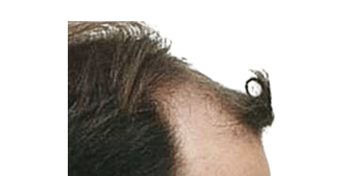Before Image: Strip-FUT Hair Transplant - right-side