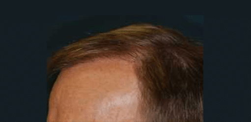 After Image: Strip-FUT Hair Transplant - left-front-oblique