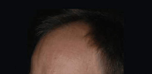 Before Image: Strip-FUT Hair Transplant - left-front-oblique