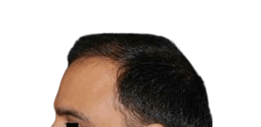 After Image: Strip-FUT Hair Transplant - left-front-oblique