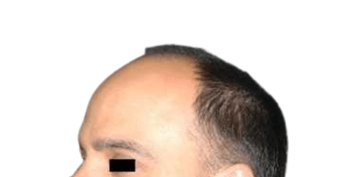 Before Image: Strip-FUT Hair Transplant - left-front-oblique