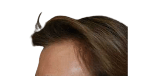 After Image: Strip-FUT Hair Transplant - left-front-oblique