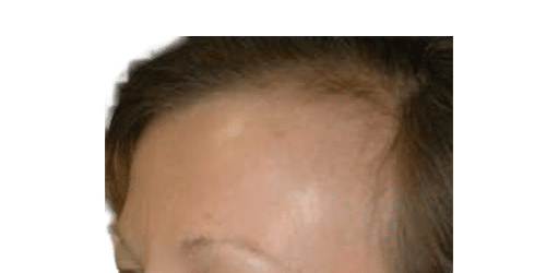 Before Image: Strip-FUT Hair Transplant - left-front-oblique