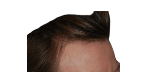 After Image: Strip-FUT Hair Transplant - right-front-oblique