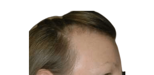Before Image: Strip-FUT Hair Transplant - right-front-oblique