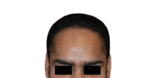 After Image: Strip-FUT Hair Transplant - front