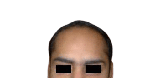 Before Image: Strip-FUT Hair Transplant - front