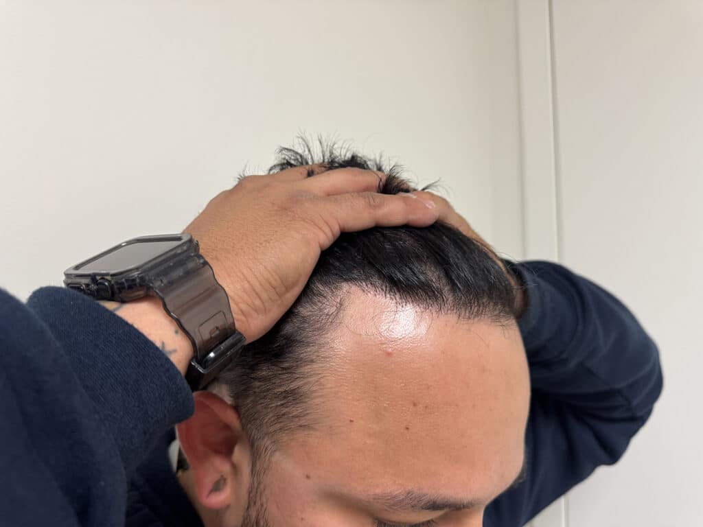 After Image: Strip-FUT Hair Transplant Before & After Results - right-front-oblique
