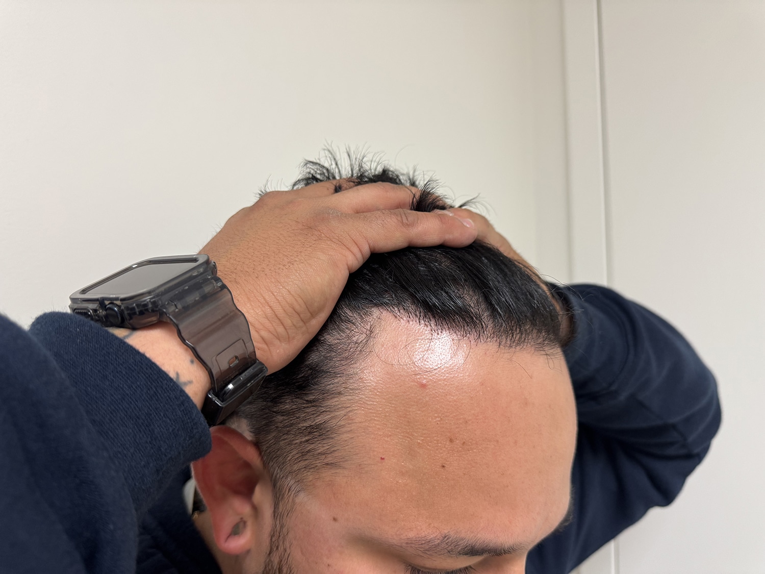 After Image: Strip-FUT Hair Transplant - right-front-oblique