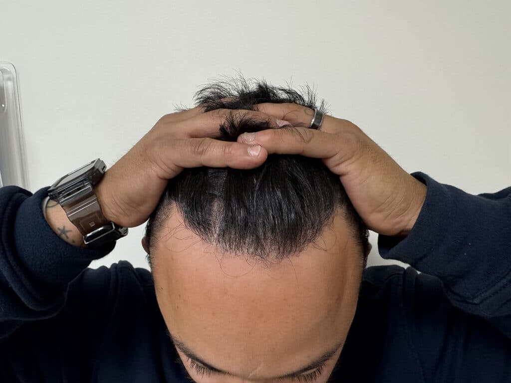 After Image: Strip-FUT Hair Transplant Before & After Results - front