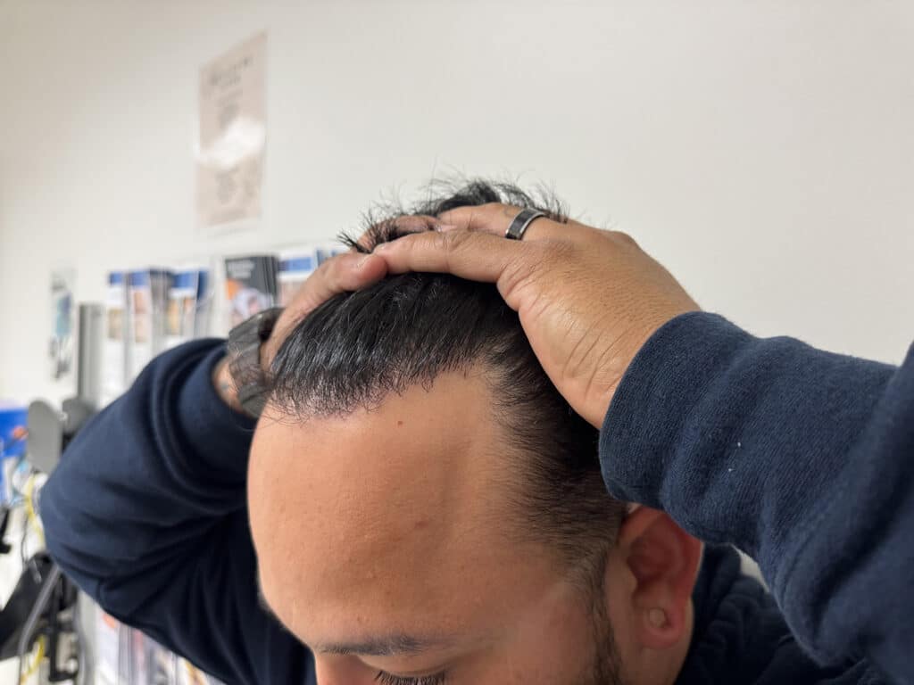 After Image: Strip-FUT Hair Transplant Before & After Results - left-front-oblique