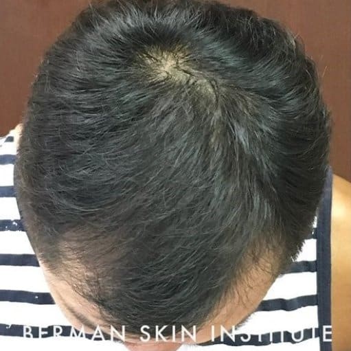 After Image: Hair Transplant - front