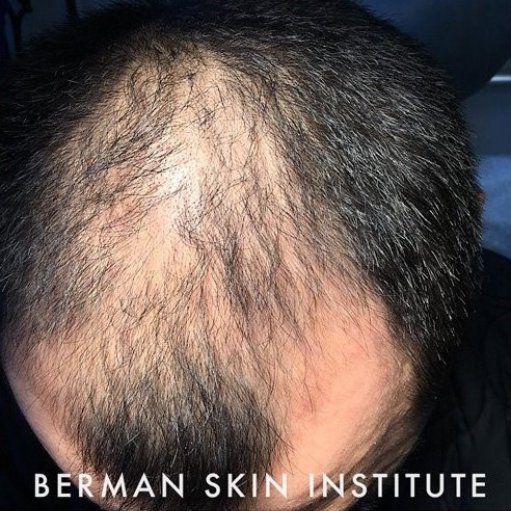 Before Image: Hair Transplant - front