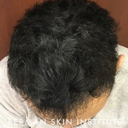 After Image: Hair Transplant - front