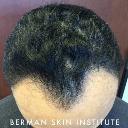 Before Image: Hair Transplant - front