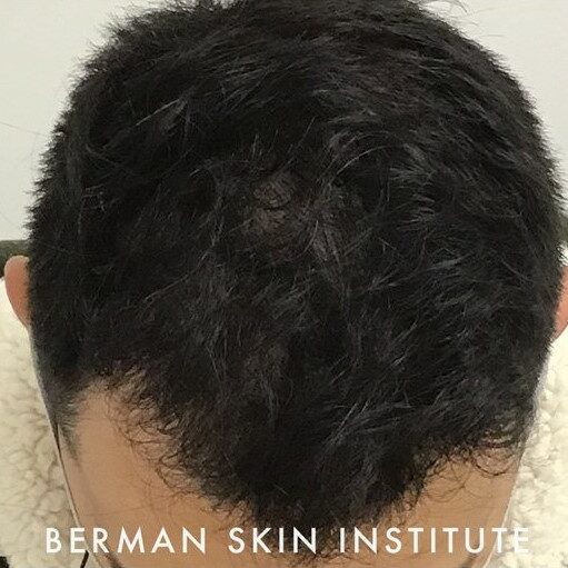 After Image: Hair Transplant - front