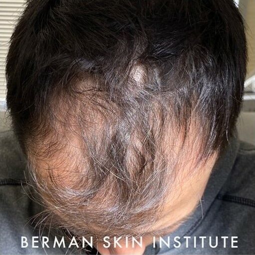 Before Image: Hair Transplant - front