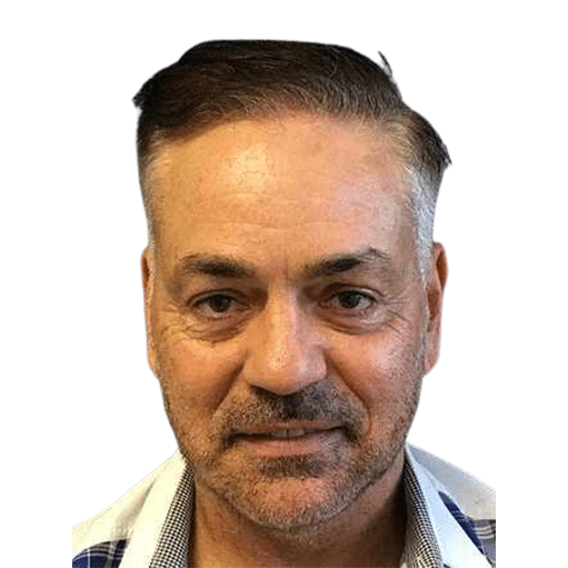 After Image: Hair Transplant - front