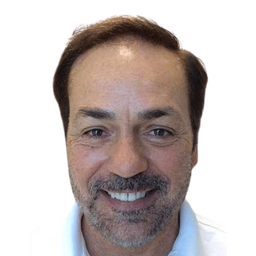 Before Image: Hair Transplant - front
