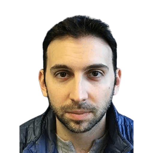 After Image: Hair Transplant - front
