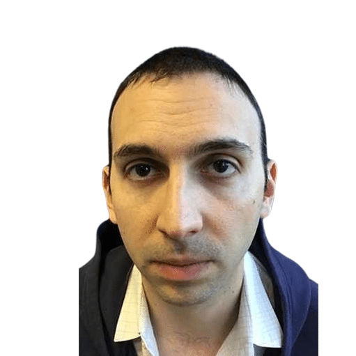 Before Image: Hair Transplant - front