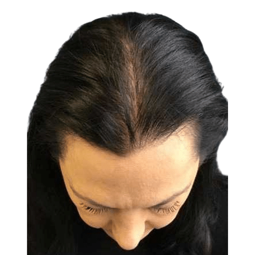 After Image: Hair Transplant - front