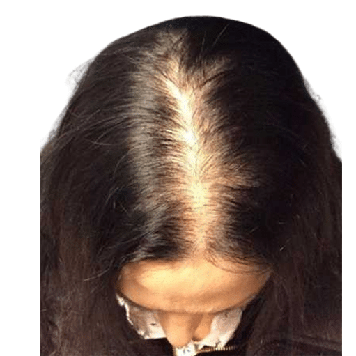 Before Image: Hair Transplant - front