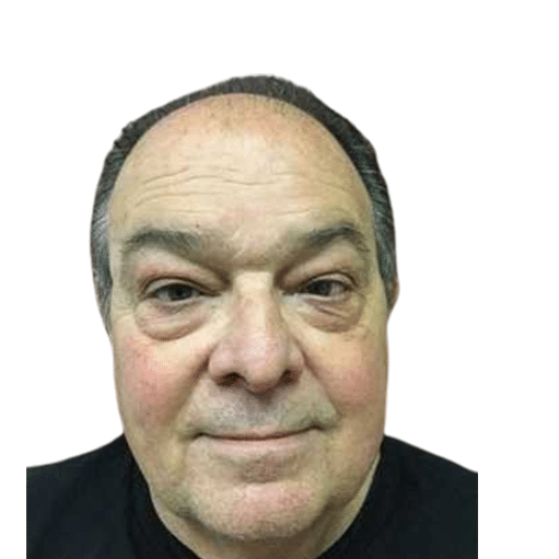 Before Image: Hair Transplant - front