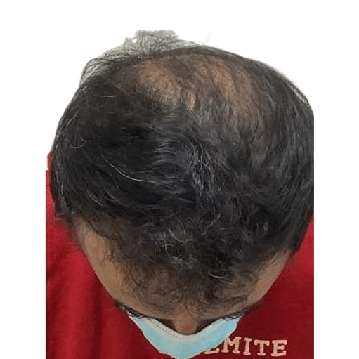 After Image: Hair Transplant - front