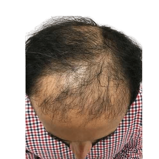 Before Image: Hair Transplant - front