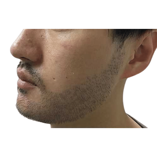 After Image: Hair Transplant - left-side